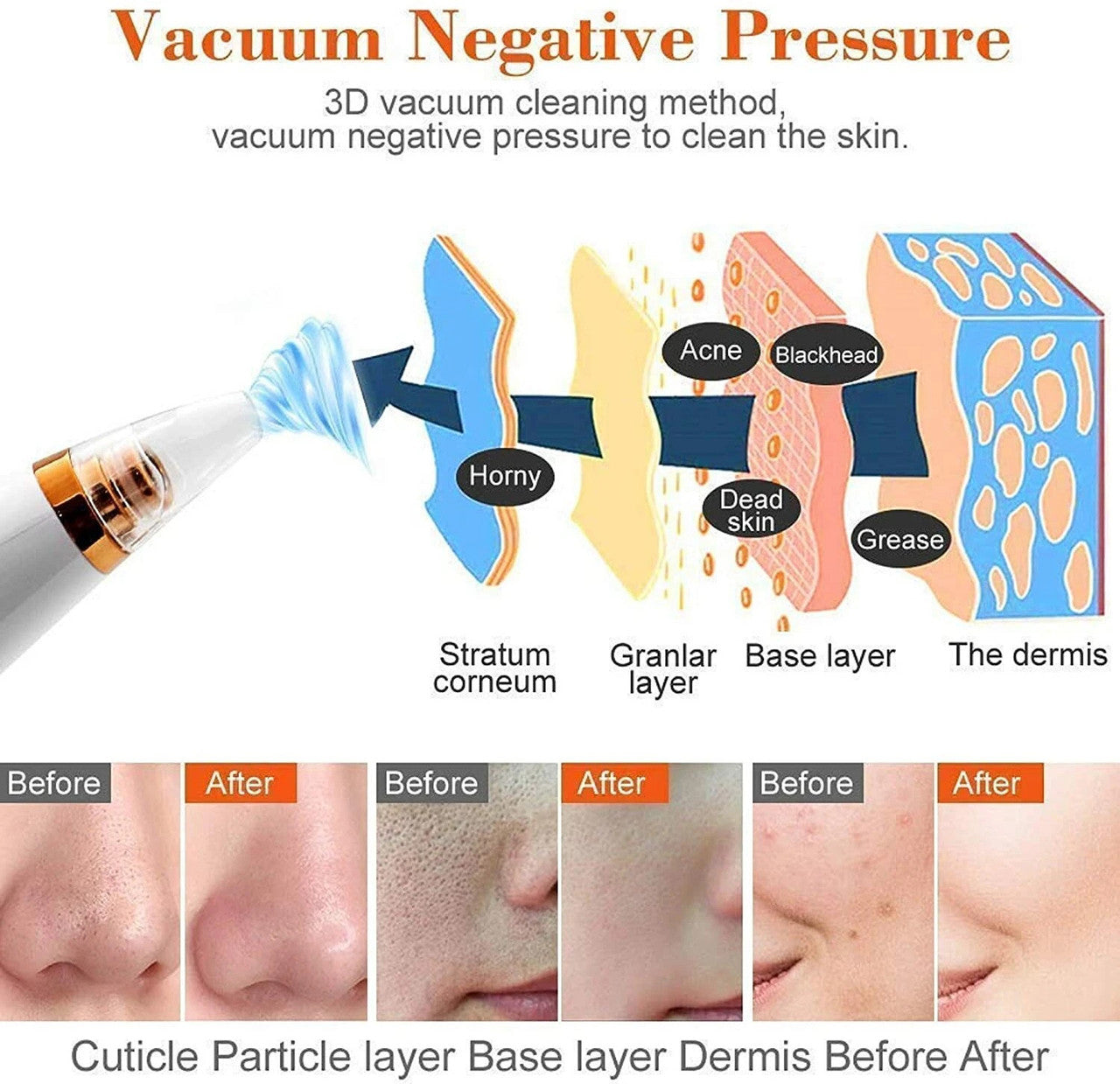 Blackhead Remover Derma Suction for Face